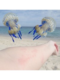 Jelly Fish Bite